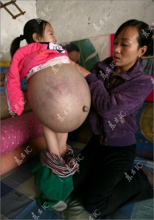 В Китае девочку избавили от огромного живота (4 фото)