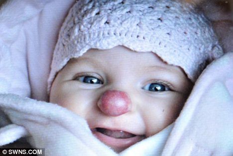 Девочка с врожденным носом клоуна (3 фото)