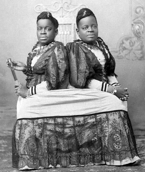 10 любопытных историй о знаменитых сиамских близнецах