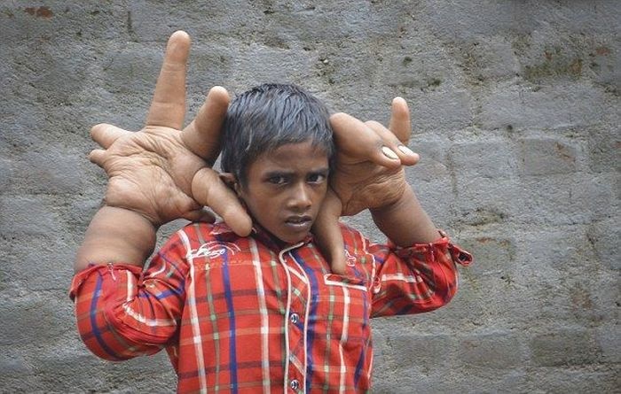 Индийский мальчик с гигантскими руками (17 фото)