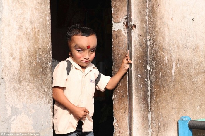 Мальчика с дефектом черепа считают реинкарнацией Индуистского Бога