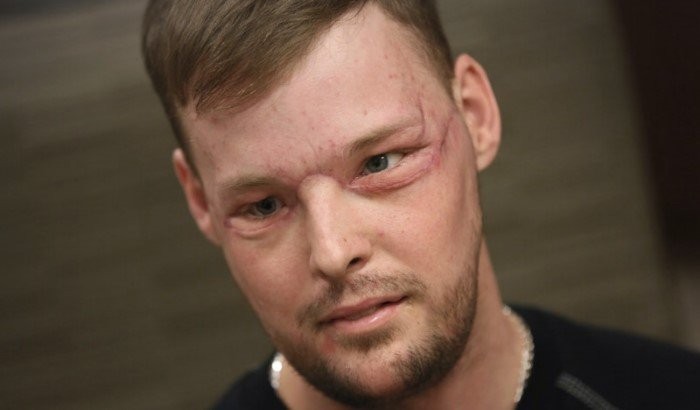 Невероятные результаты пересадки лица, сделанной после того, как он выстрелил себе в лицо (13 фото)