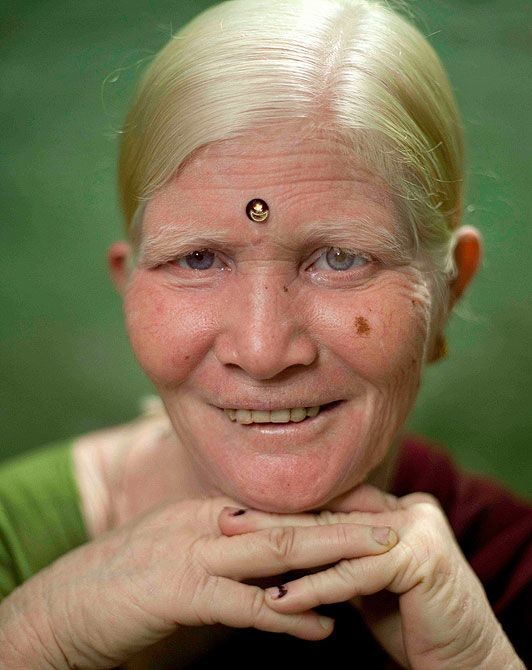 Индийская семья альбиносов (6 фото)