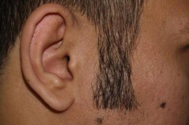 Пересадка бороды (4 фото)