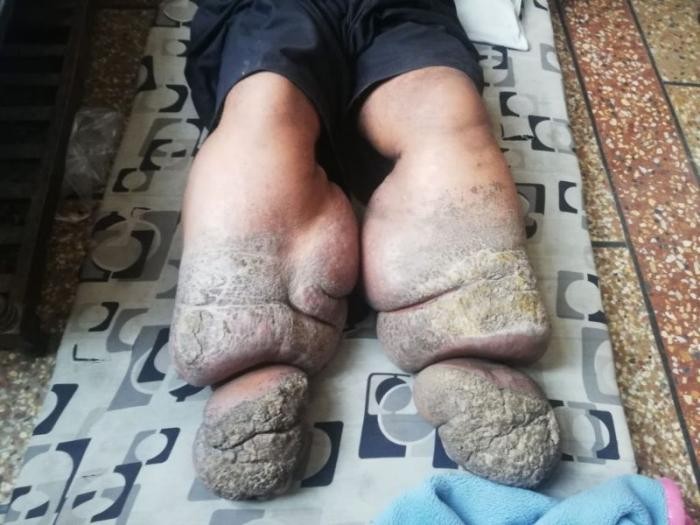 Из-за укуса комара у 38-летнего мужика огромные каменные ноги (4 фото)