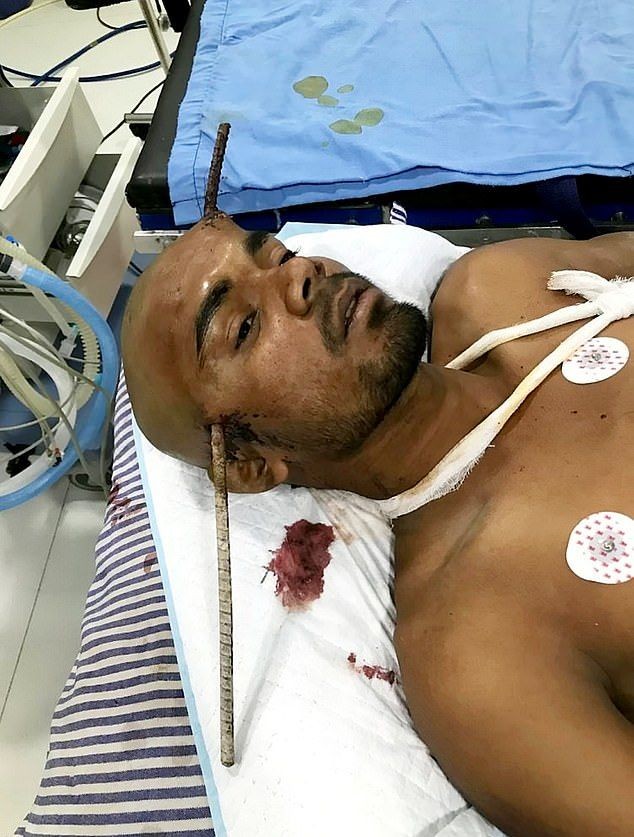 Индийский строитель получил необычную травму и выжил (6 фото)