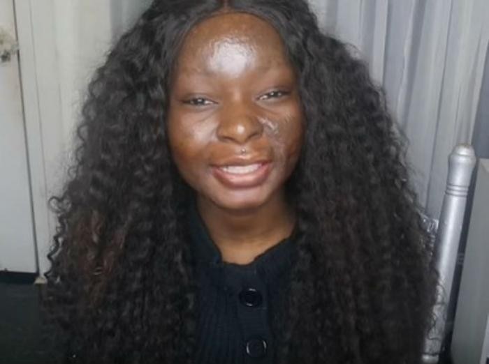 Девушка с сильнейшими ожогами лица показывает силу макияжа (10 фото)