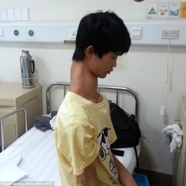 Китай: 15-летний подросток с самой длинной шеей в мире