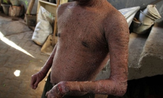 Мальчик-змея вынужден менять кожу раз в 41 день, чтобы не умереть (5 фото)