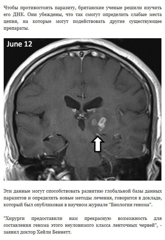 Великобритания: паразитический червь 4 года блуждает по мозгу человека (6 фото)