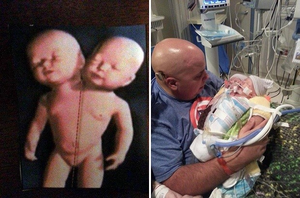 В Америке родился двухголовый ребенок (6 фото)