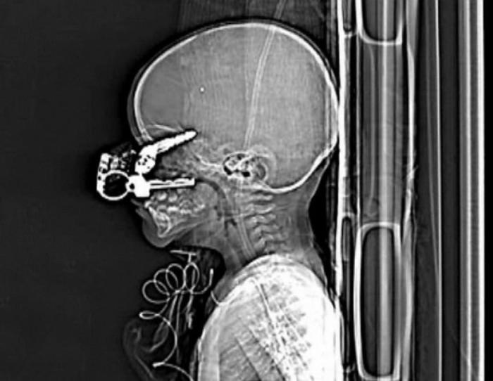 Предметы, которые можно обнаружить в теле человека с помощью рентгена (37 фото)