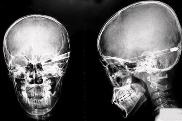 Предметы, которые можно обнаружить в теле человека с помощью рентгена (37 фото)