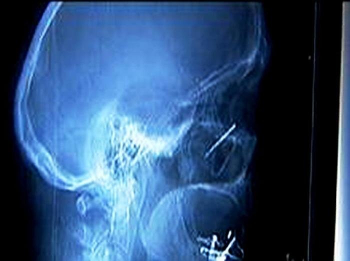 Предметы, которые можно обнаружить в теле человека с помощью рентгена (37 фото)
