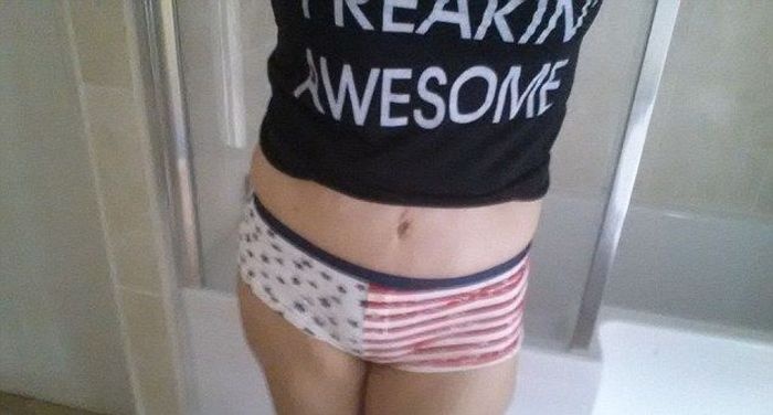 Результаты удаления лишней кожи (4 фото)