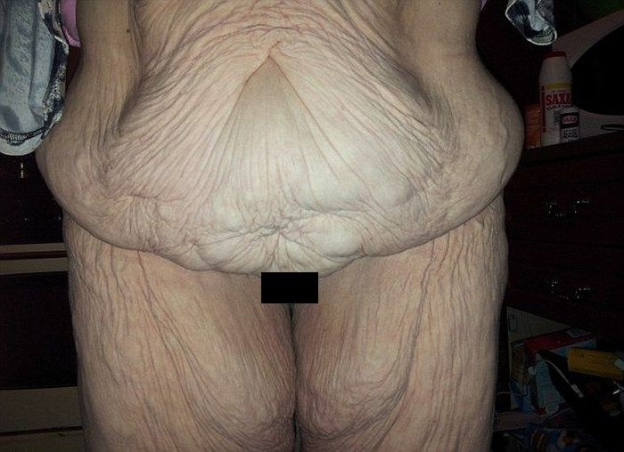 Результаты удаления лишней кожи (4 фото)