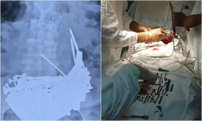 Бурятская пенсионерка проглотила 152 железяки, чтобы вылечить анемию (4 фото)