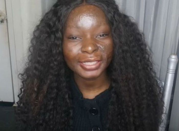 Девушка с ожогами лица наглядно демонстрирует силу макияжа (8 фото)