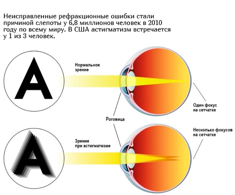 Как видят мир люди, страдающие от астигматизма